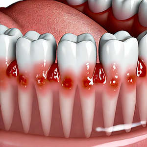 잇몸 치료 마취 도움 되는 팁